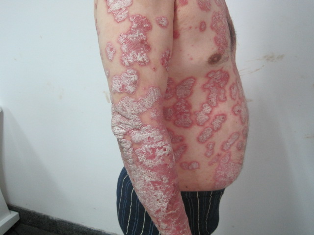 長春膚康皮膚科治療牛皮癬