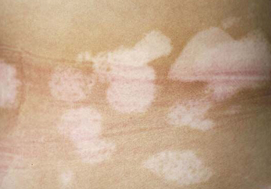 長春皮膚病醫院