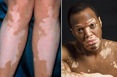 長春皮膚病專科醫院