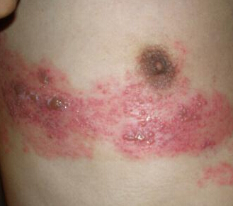 長春胸部帶狀皰疹圖片