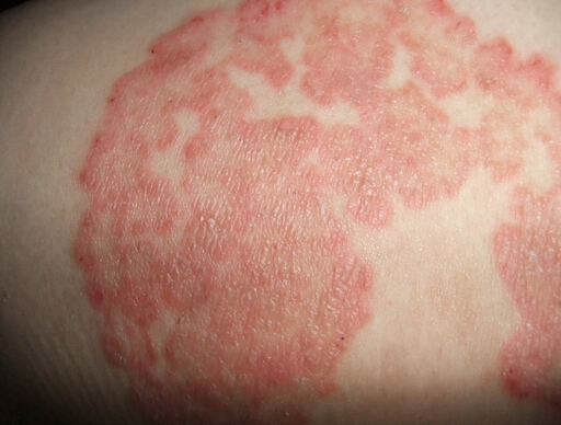 長春膚康醫(yī)院專業(yè)治療濕疹