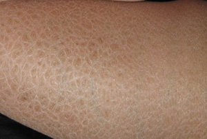 長春膚康醫院,專業治療魚鱗病