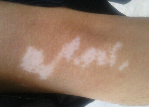 長春膚康醫(yī)院專業(yè)治療白癜風(fēng)