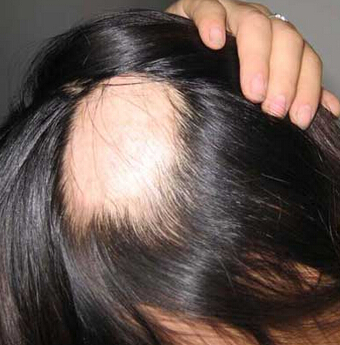 長春膚康醫院專業治療脫發