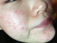 青春痘癥狀患者