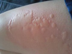 蕁麻疹患者癥狀圖