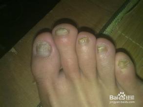 腳部灰指甲