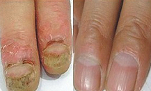 灰指甲治療選長春膚康醫院