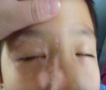 臉部白癜風(fēng)