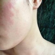 臉部皮膚過敏癥狀圖