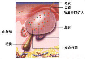下巴長痘痘的原因示意圖