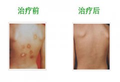 白癜風(fēng)治療效果圖