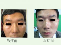 白癜風(fēng)治療患者圖
