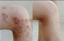 濕疹患者圖