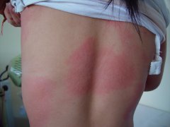 皮膚瘙癢起紅疙瘩癥狀