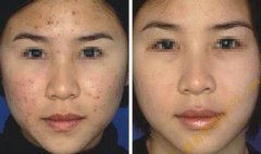 雀斑的表現(xiàn)