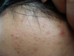 長(zhǎng)春膚康醫(yī)院介紹額頭的痘痘原因