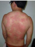 長(zhǎng)春皮膚病醫(yī)院介紹蕁麻疹