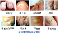 灰指甲的各類癥狀表現