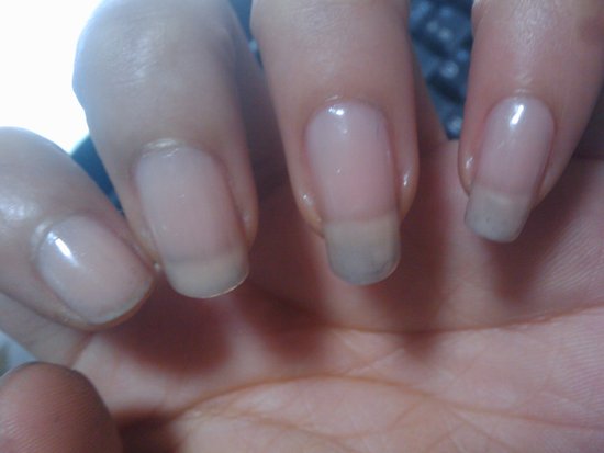 長春膚康醫院灰指甲