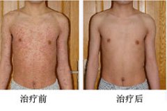 長春皮膚病醫院治療蕁麻疹患者