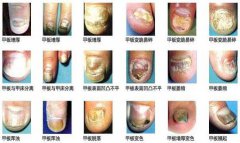 長春膚康醫院介紹灰指甲種類