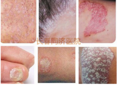 牛皮癬的治療