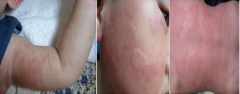 蕁麻疹癥狀,治療,病因