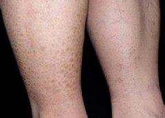 長春魚鱗病醫院