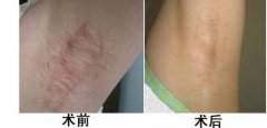 長春治療疤痕