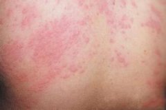 濕疹的治療癥狀