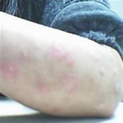 長(zhǎng)春治療牛皮癬醫(yī)院