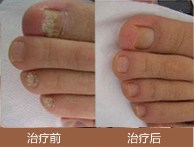 長春灰指甲治療醫院