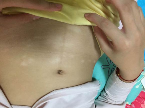 白癜風(fēng)治療