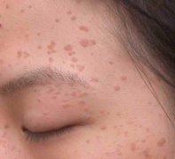 扁平疣的癥狀表現