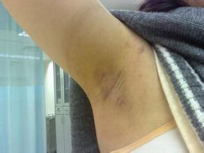 長春治療腋臭醫院