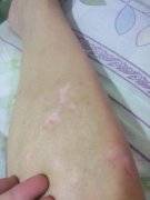 長春治療白癜風醫(yī)院