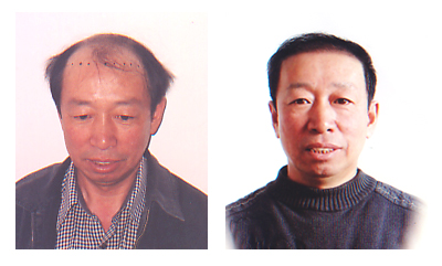 長春膚康醫(yī)院治療脫發(fā)