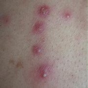 毛囊炎的表現癥狀