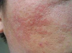 皮炎的表現癥狀