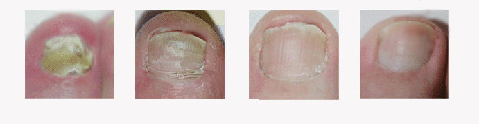 灰指甲的癥狀表現(xiàn)