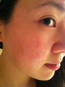 皮膚過(guò)敏的癥狀表現(xiàn)