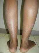 長春魚鱗病醫院