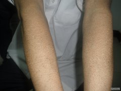 魚鱗病的癥狀表現(xiàn)