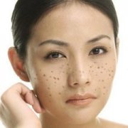 雀斑患者的癥狀表現