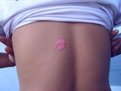 牛皮癬的表現(xiàn)癥狀