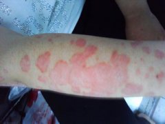 牛皮癬的表現(xiàn)癥狀