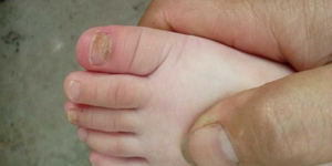 灰指甲帶來的并發(fā)癥有幾種