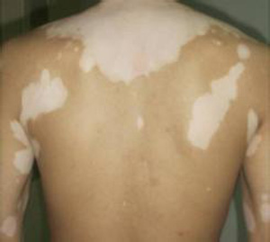 散發型白癜風患者要注意什么