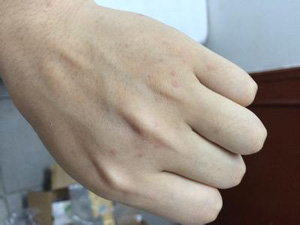 皮膚劃痕癥是什么?劃痕癥應該怎么治療?